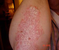 getuigschrift Psoriasis Vulgaris